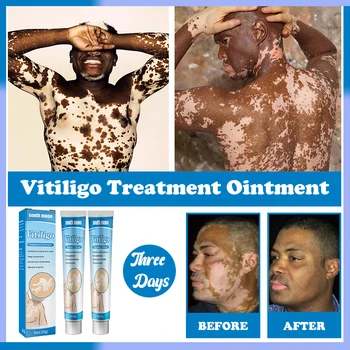 Gyógynövény Kivonat Vitiligo Kenőcs Távolítsa El Ótvar Fehér Folt Eltávolítása A Bőr Fehér Folt Leukoplakia Betegség Kezelése Krém